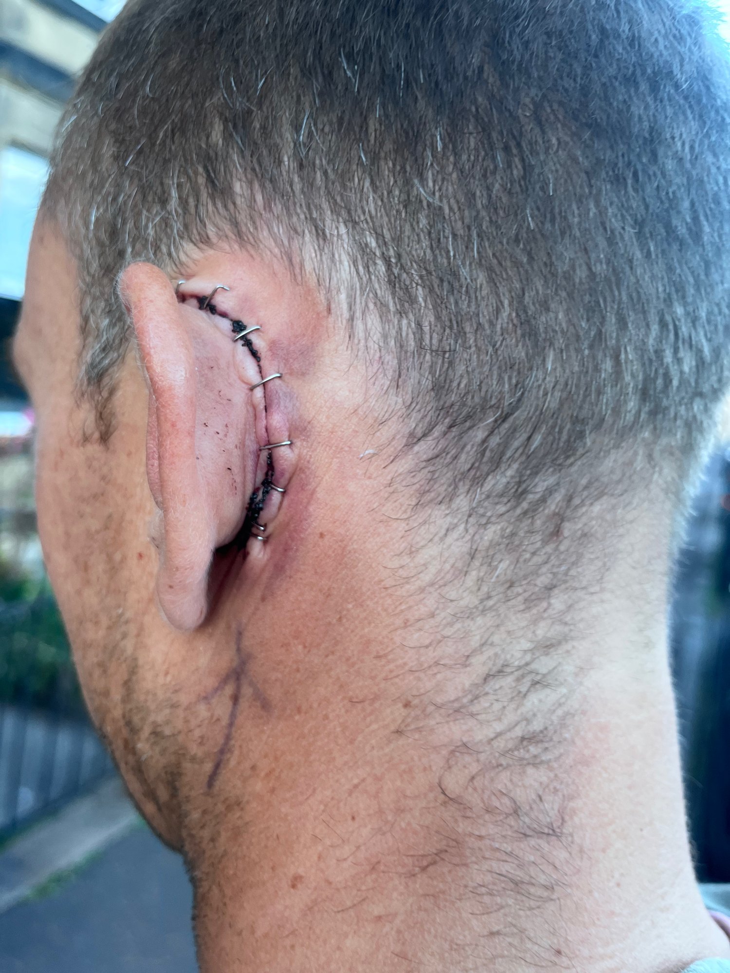 The back of Mark Boyd's left ear held in place with staples after surgery